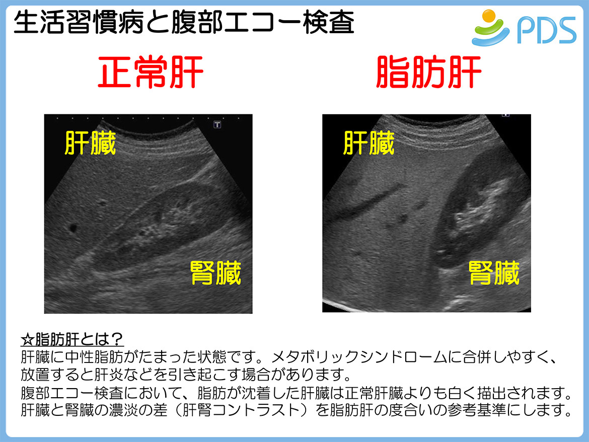 生活習慣病と腹部エコー検査