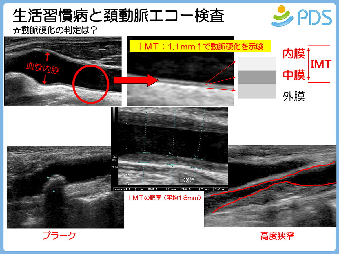 生活習慣病と頚動脈エコー検査