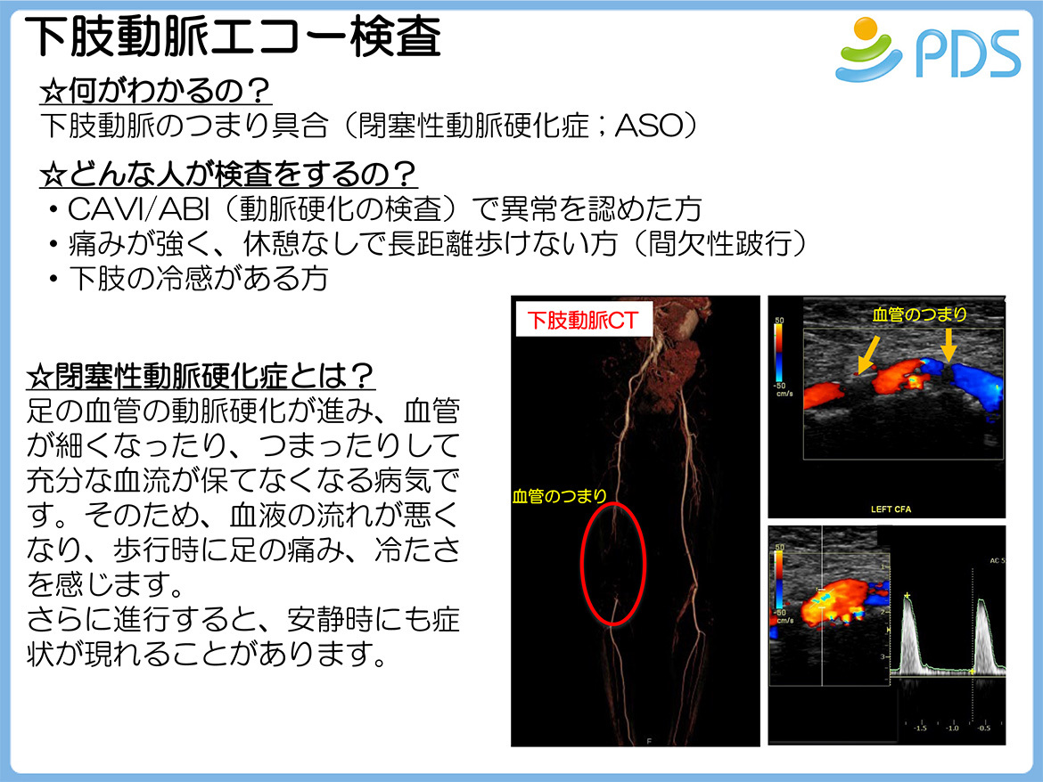 下肢動脈エコー検査